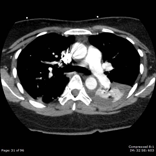 Bilateral pulmonary emboli with Hampton hump sign (Radiopaedia 54070-60246 Axial C+ CTPA 28).jpg