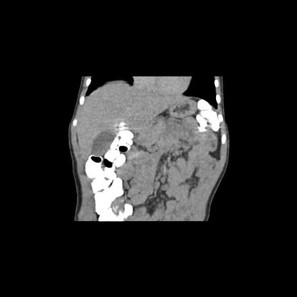 File:Bilateral renal malrotation (Radiopaedia 30901-31606 B 61).jpg