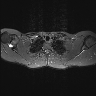 File:Bilateral spinoglenoid notch ganglion cysts (Radiopaedia 29577-30082 Axial STIR 17).jpg
