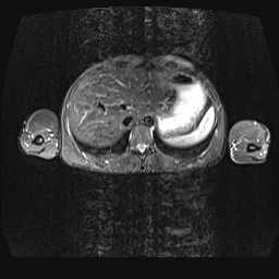 File:Bilateral spinoglenoid notch ganglion cysts (Radiopaedia 29577-30082 E 32).jpg