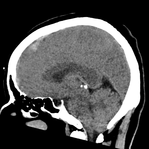 File:Bilateral subacute subdural hematoma (Radiopaedia 69240-79018 C 27).jpg