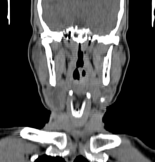 Bilateral submandibular sialolithiasis with sialadenitis (Radiopaedia 70721-80881 Coronal non-contrast 47).jpg