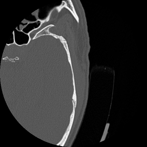 Bilateral temporal bone fractures (Radiopaedia 29482-29970 D 147).jpg