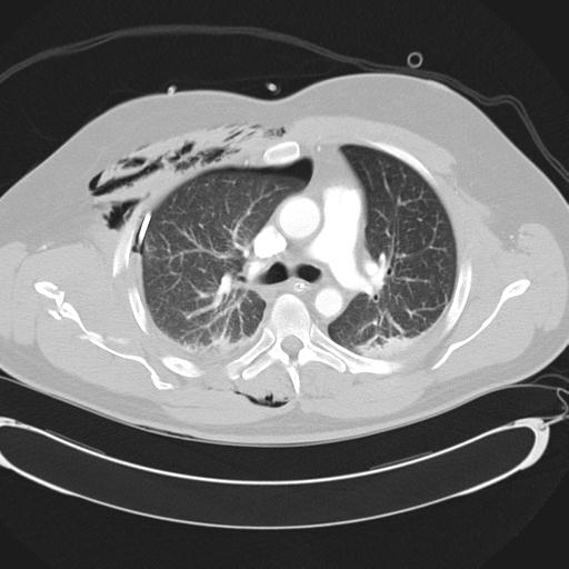 Bilateral traumatic renovascular injury (Radiopaedia 32051-32995 Axial lung window 21).jpg