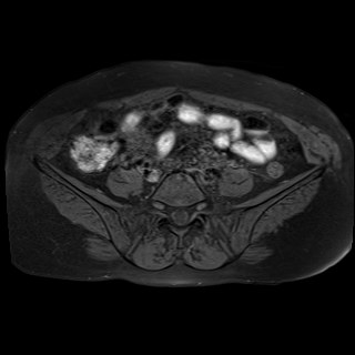 Bilateral tubo-ovarian abscesses (Radiopaedia 58635-65829 Axial T1 fat sat 1).jpg