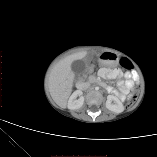 Biliary tract embryonal rhabdomyosarcoma (Radiopaedia 51815-57648 A 62).jpg