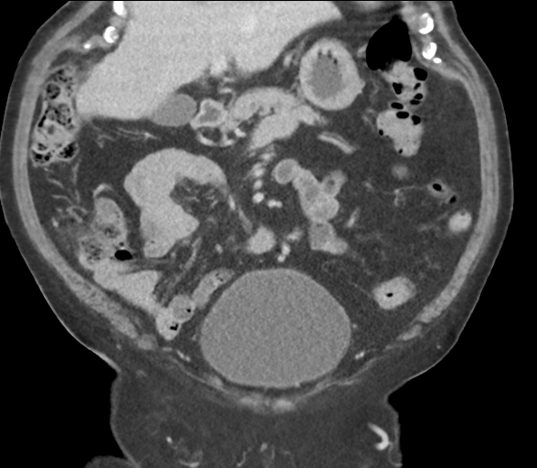 File:Bladder papillary urothelial carcinoma (Radiopaedia 48119-52951 C 27).png