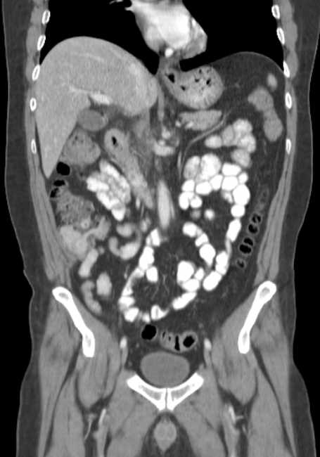 Bleeding duodenal ulcer and adenomyomatosis of gallbladder (Radiopaedia 61834-69861 B 46).jpg