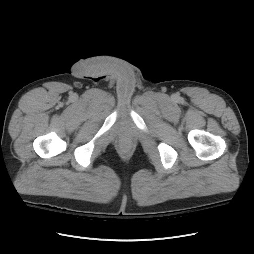 File:Blunt abdominal trauma with solid organ and musculoskelatal injury with active extravasation (Radiopaedia 68364-77895 Axial C+ delayed 146).jpg