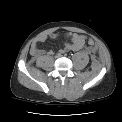 Blunt abdominal trauma with solid organ and musculoskelatal injury with active extravasation (Radiopaedia 68364-77895 Axial C+ delayed 94).jpg