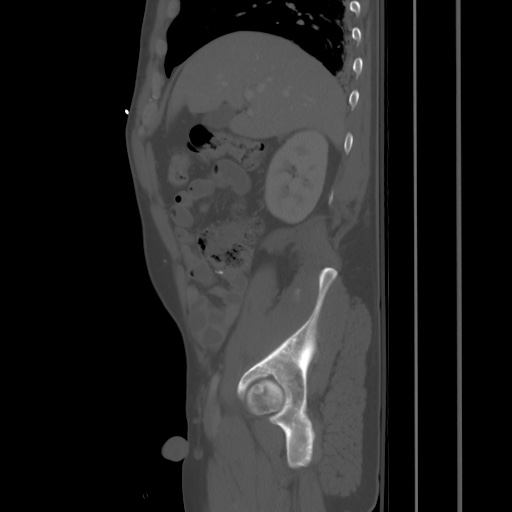 Blunt abdominal trauma with solid organ and musculoskelatal injury with active extravasation (Radiopaedia 68364-77895 Sagittal bone window 23).jpg