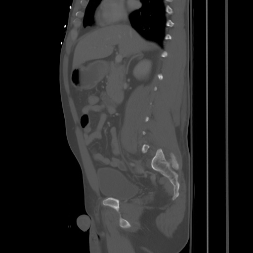 Blunt abdominal trauma with solid organ and musculoskelatal injury with active extravasation (Radiopaedia 68364-77895 Sagittal bone window 39).jpg