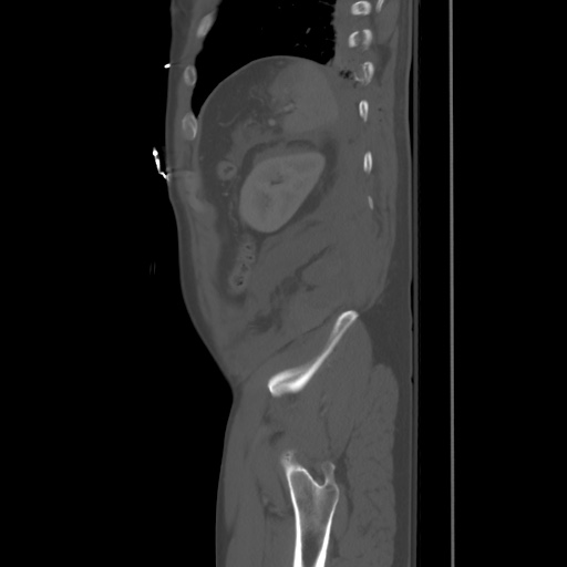 File:Blunt abdominal trauma with solid organ and musculoskelatal injury with active extravasation (Radiopaedia 68364-77895 Sagittal bone window 93).jpg