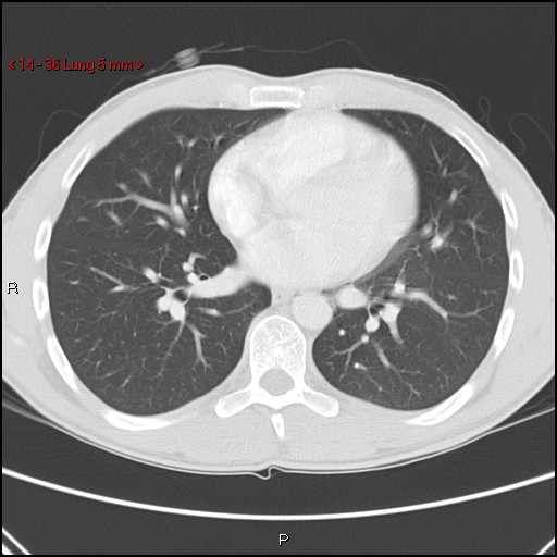 Blunt chest trauma - pulmonary interstitial emphysema and pneumomediastinum (Radiopaedia 20666-20552 Axial lung window 36).jpg