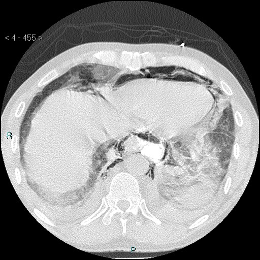 Boerhaave syndrome (Radiopaedia 27683-27897 lung window 87).jpg