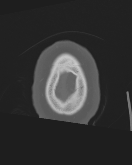 Bone-anchored hearing aid (Radiopaedia 38708-40866 Axial bone window 7).png