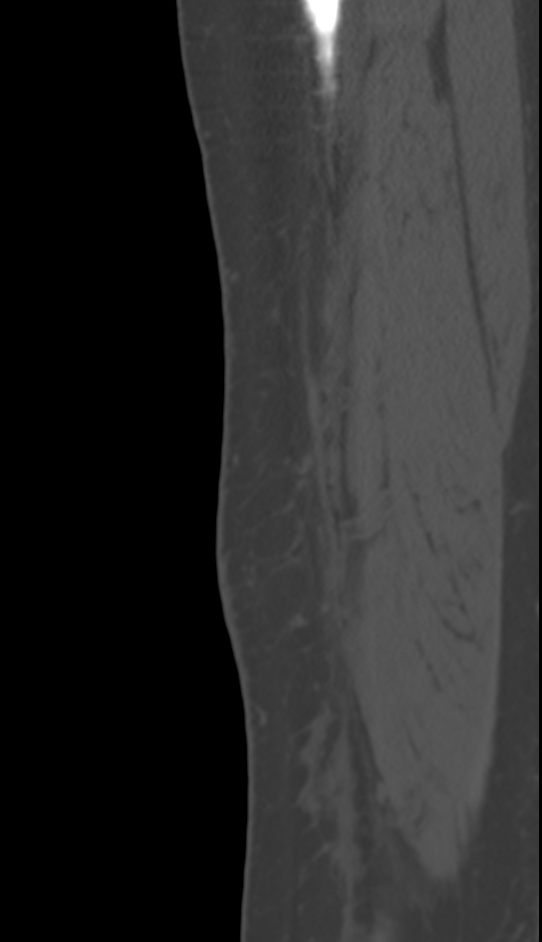Bone metastasis - tibia (Radiopaedia 57665-64609 Sagittal bone window 24).jpg