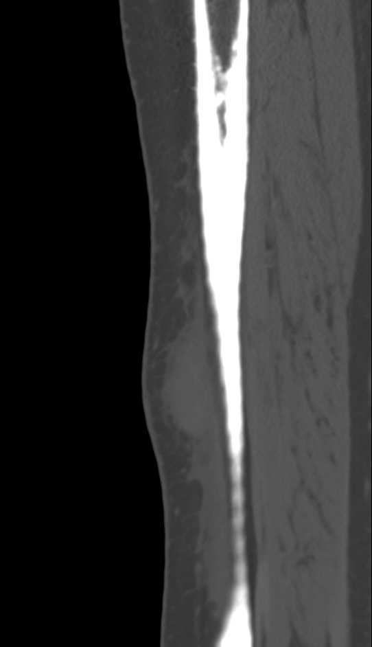 Bone metastasis - tibia (Radiopaedia 57665-64609 Sagittal bone window 41).jpg
