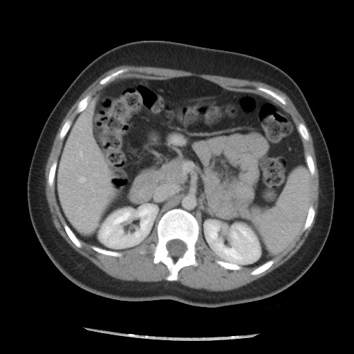 File:Borderline mucinous tumor (ovary) (Radiopaedia 78228-90808 A 79).jpg