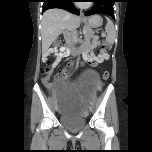 Borderline mucinous tumor (ovary) (Radiopaedia 78228-90808 C 27).jpg