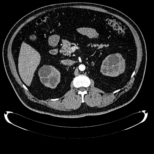 File:Bosniak renal cyst - type IV (Radiopaedia 24244-24518 B 120).jpg