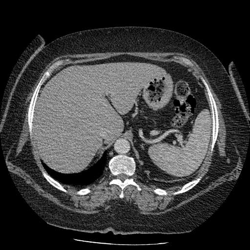 Bovine aortic arch - right internal mammary vein drains into the superior vena cava (Radiopaedia 63296-71875 A 160).jpg