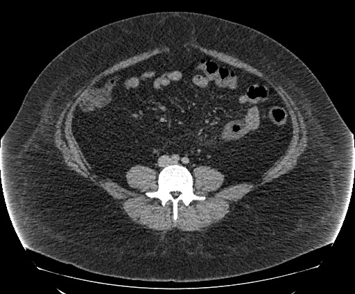 Bowel and splenic infarcts in acute lymphocytic leukemia (Radiopaedia 61055-68913 A 80).jpg