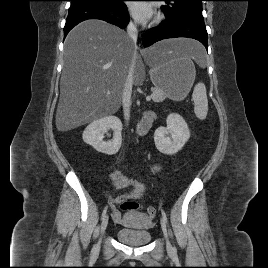 Bowel and splenic infarcts in acute lymphocytic leukemia (Radiopaedia 61055-68913 B 32).jpg