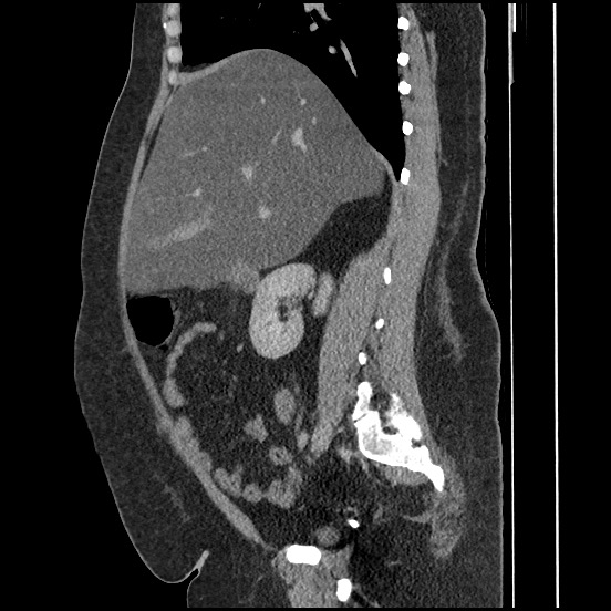 Bowel and splenic infarcts in acute lymphocytic leukemia (Radiopaedia 61055-68913 C 49).jpg