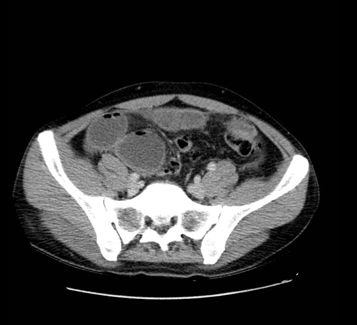 Bowel obstruction from colon carcinoma (Radiopaedia 22995-23028 A 64).jpg