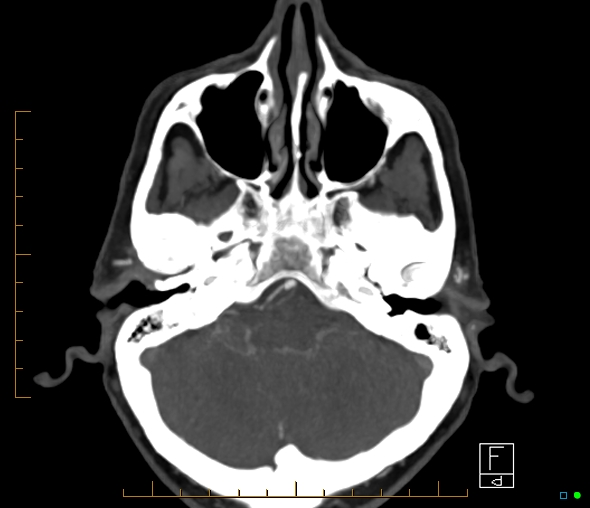 Brachiocephalic trunk stenosis (Radiopaedia 87242-103519 A 55).jpg