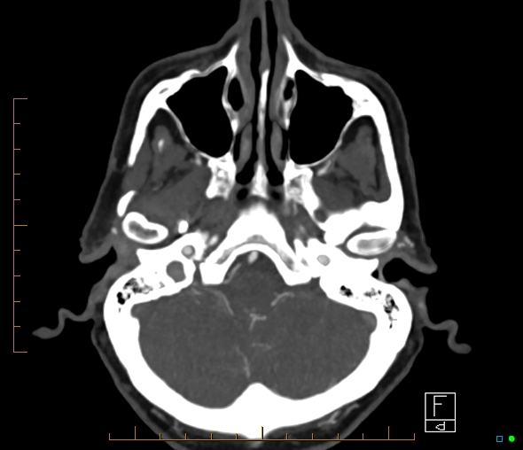 Brachiocephalic trunk stenosis (Radiopaedia 87242-103519 A 57).jpg