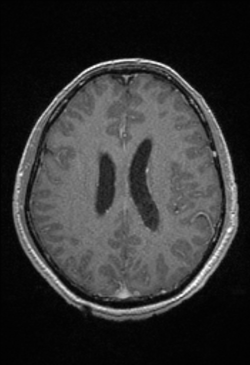 Brain abscess with ventriculitis (Radiopaedia 85703-101495 Axial T1 C+ 115).jpg