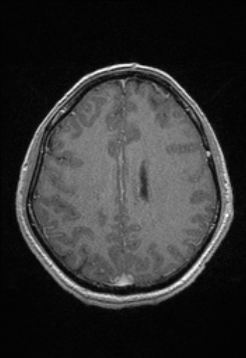 Brain abscess with ventriculitis (Radiopaedia 85703-101495 Axial T1 C+ 123).jpg