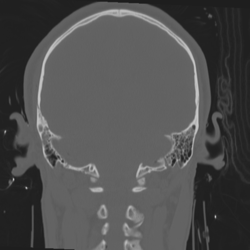 File:Brain contusions, internal carotid artery dissection and base of skull fracture (Radiopaedia 34089-35339 Coronal bone window 47).png