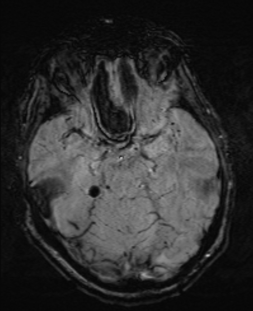 Brain metastases - lung cancer primary (Radiopaedia 75060-86115 Axial SWI 24).jpg