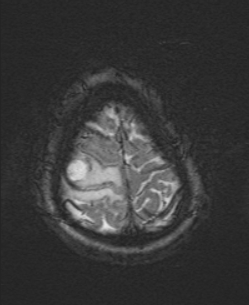 Brain metastases - lung cancer primary (Radiopaedia 75060-86115 Axial SWI 55).jpg