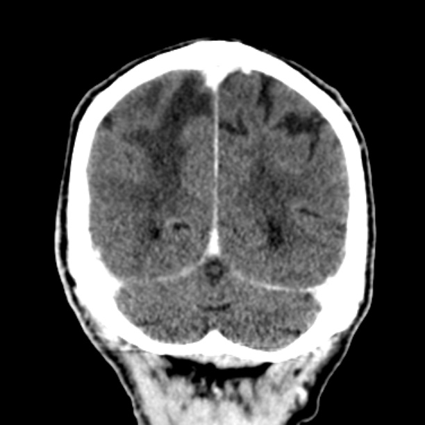 Brain metastases from lung cancer (Radiopaedia 27849-28092 Coronal C+ delayed 53).jpg