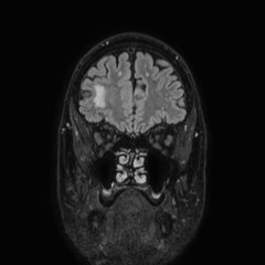 Brain metastases from lung cancer (Radiopaedia 83839-99028 Coronal FLAIR 14).jpg