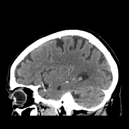 Brain metastasis (Radiopaedia 42617-45760 D 13).jpg