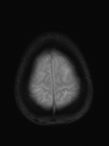 File:Brain metastasis as initial presentation of non-small cell lung cancer (Radiopaedia 65122-74126 Axial T2* 17).jpg
