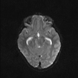 Brainstem glioma (Radiopaedia 67531-76922 Axial DWI 11).jpg