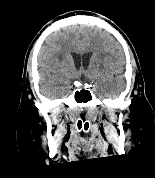 Brainstem hemorrhage (Radiopaedia 81294-94976 Coronal non-contrast 29).jpg