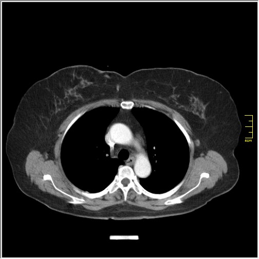 Breast cancer on thorax CT (Radiopaedia 60571-68275 A 34).JPG
