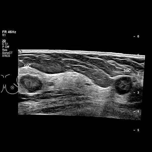 File:Breast metastases from renal cell cancer (Radiopaedia 79220-92226 Left breast US 13).jpeg