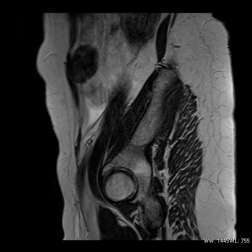File:Broad ligament fibroid (Radiopaedia 49135-54241 Sagittal T2 2).jpg