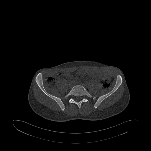 Brodie abscess- femoral neck (Radiopaedia 53862-59966 Axial bone window 12).jpg