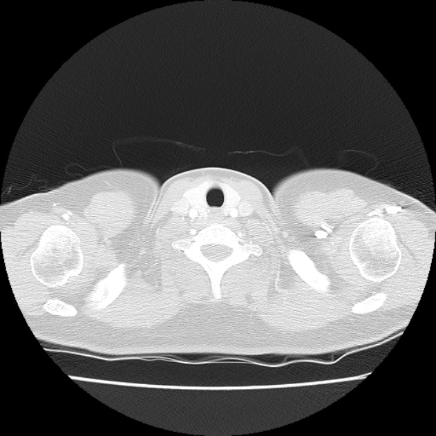 Bronchial atresia (Radiopaedia 22965-22992 Axial lung window 53).jpg