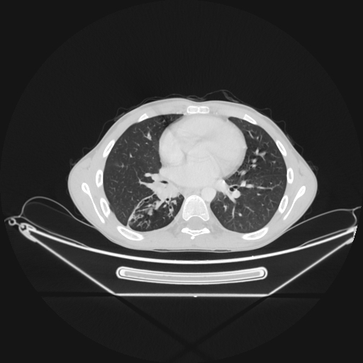 Bronchial carcinoid tumor (Radiopaedia 57187-64090 Axial lung window 45).jpg