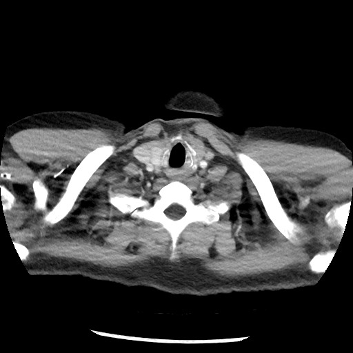 Bronchial carcinoid tumor (Radiopaedia 67377-76764 A 5).jpg